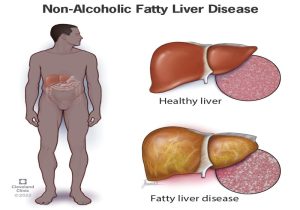 Fatty Liver